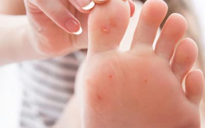 Laser Treatment for Warts