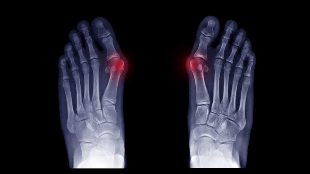 Bunions causing big toe pain